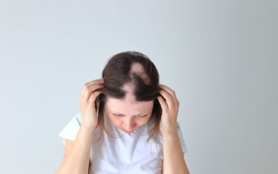 Alopecia